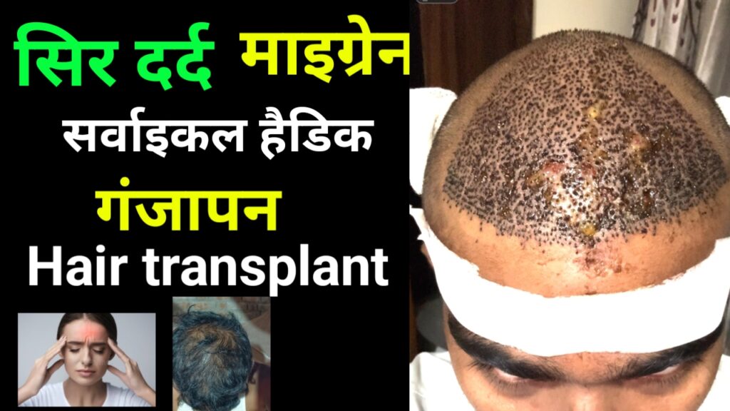 Cervical Headache की वजह से बाल झड़ रहे हैं? जानिए पूरी सच्चाई, ट्रांसप्लांट और दवाइयों के धोखे से लेकर देसी इलाज तक