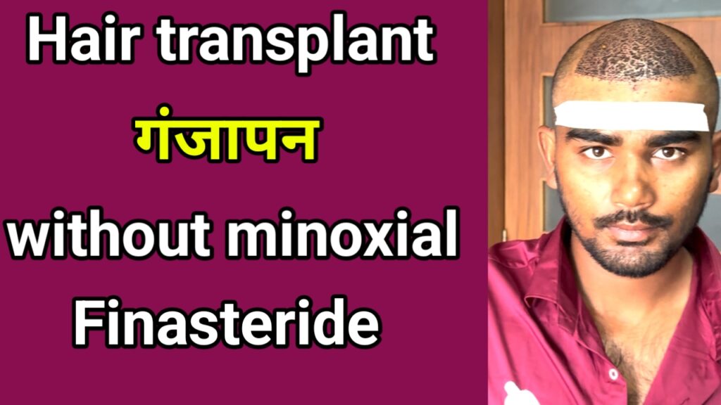 हेयर ट्रांसप्लांट के बाद मिनोक्सिडिल फिनास्टराइड नहीं ली तो क्या होगा?