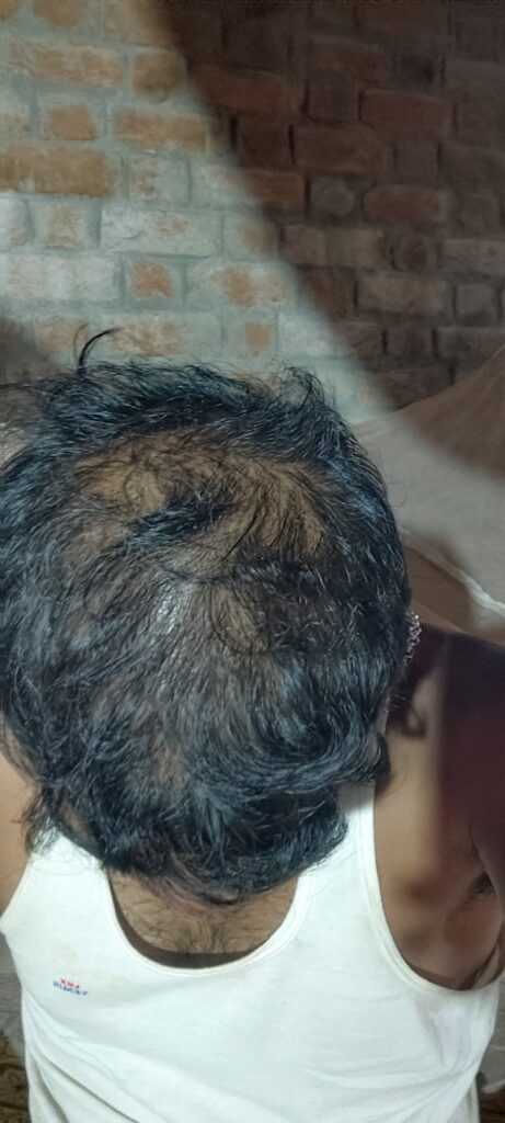 हेयर ट्रांसप्लांट के बाद मिनोक्सिडिल फिनास्टराइड नहीं ली तो क्या होगा?